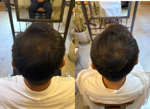 育毛改善Before / After
