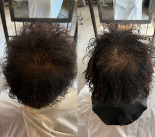 育毛改善Before / After